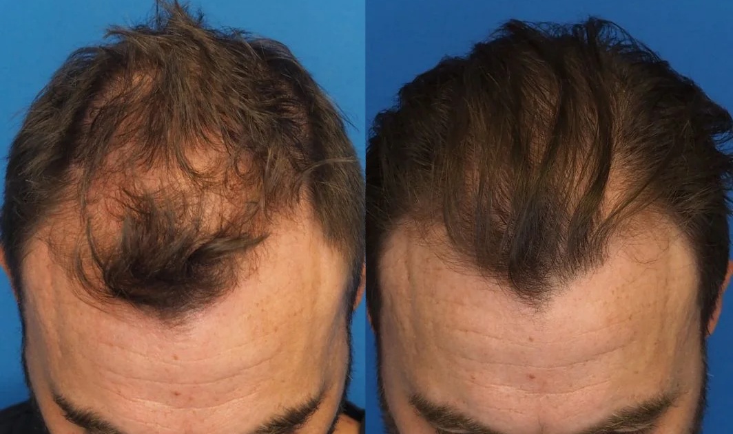 PRP vs PRF: Benefits, Procedure, Cost, Results & PRF EZGEL for Skin and Hair Rejuvenation