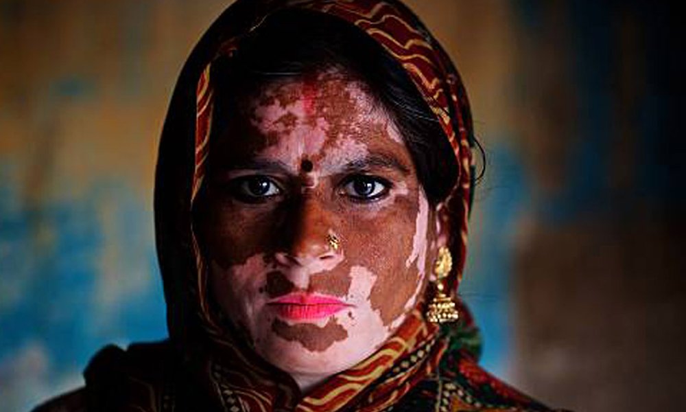 Vitiligo Treatment in Multan for Loss of Pigment treatment at Le Pearl Aesthetic Clinic
