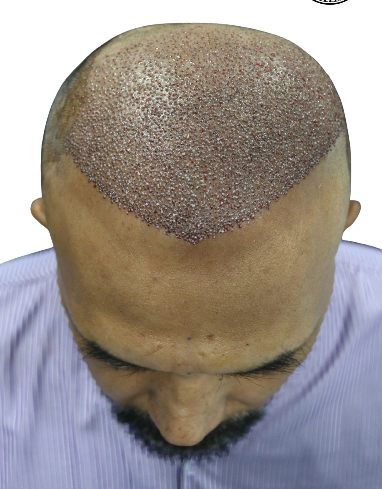 Hair Transplant in Multan for Long-Term Hairline Planning treatment at Le Pearl Aesthetic Clinic