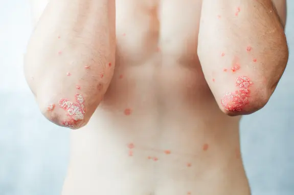 Psoriasis Treatment in Multan for Long-Term Control treatment at Le Pearl Aesthetic Clinic