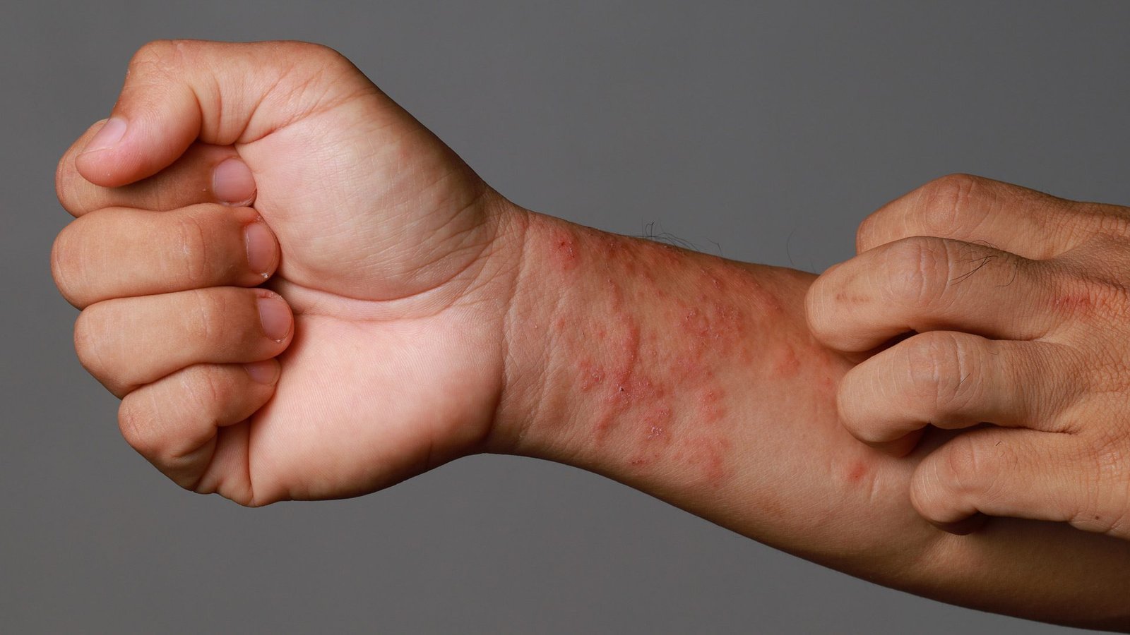 Eczema Treatment in Multan for Dry, Inflamed Skin treatment at Le Pearl Aesthetic Clinic