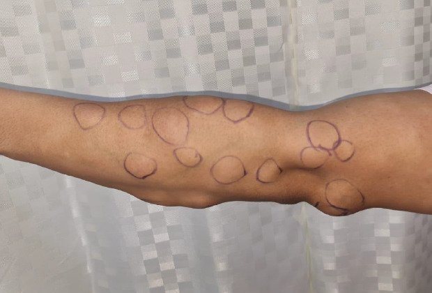 Lipoma Removal in Multan: Assessment, Excision and Recovery treatment at Le Pearl Aesthetic Clinic