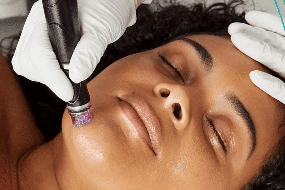 Microneedling in Multan for Scars and Uneven Texture treatment at Le Pearl Aesthetic Clinic