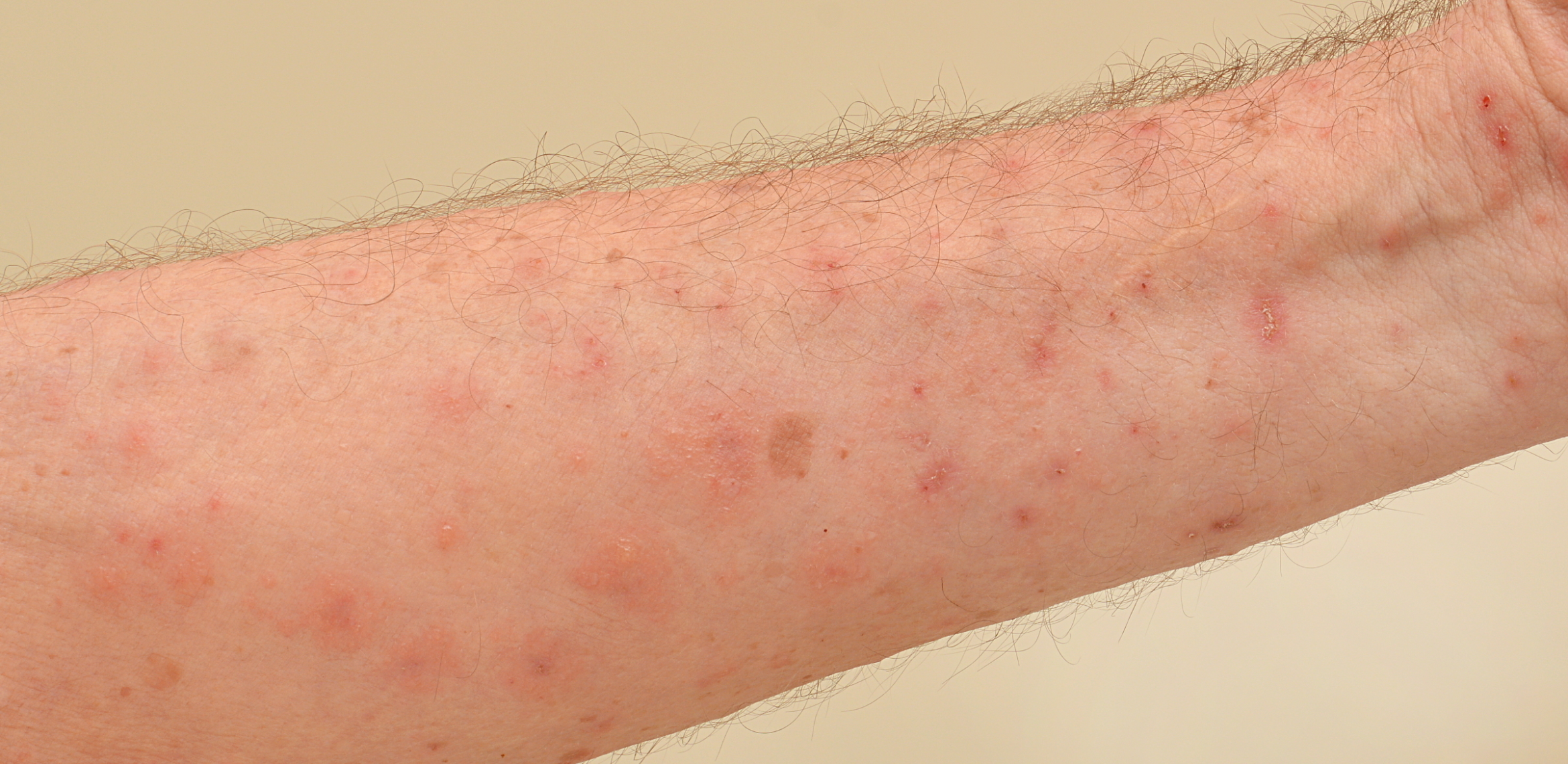 Scabies Treatment in Multan for Patients and Contacts treatment at Le Pearl Aesthetic Clinic