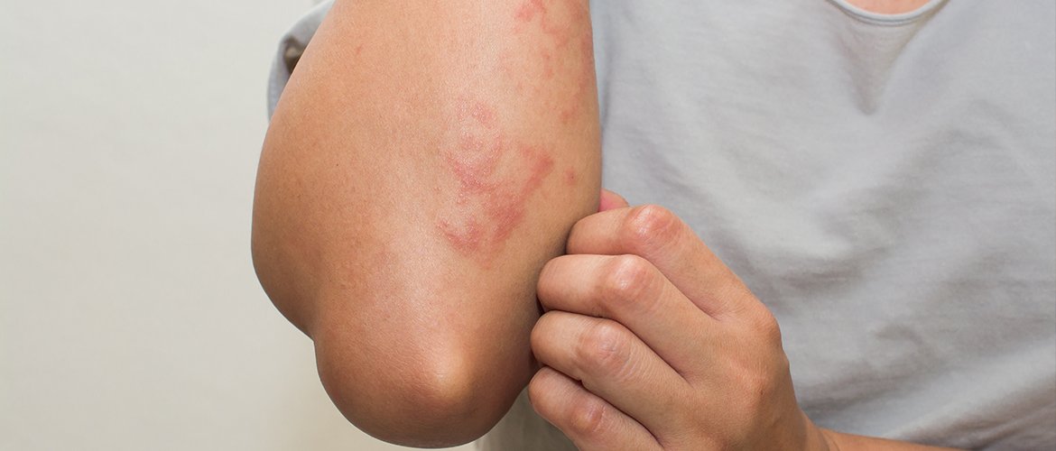 Fungal Skin Treatment in Multan by Infection Site treatment at Le Pearl Aesthetic Clinic