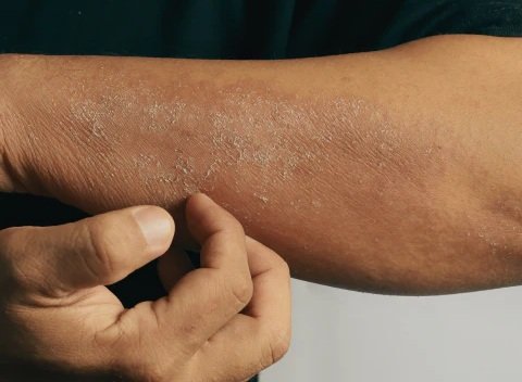Skin Allergy Treatment in Multan Starts with Rash Type treatment at Le Pearl Aesthetic Clinic