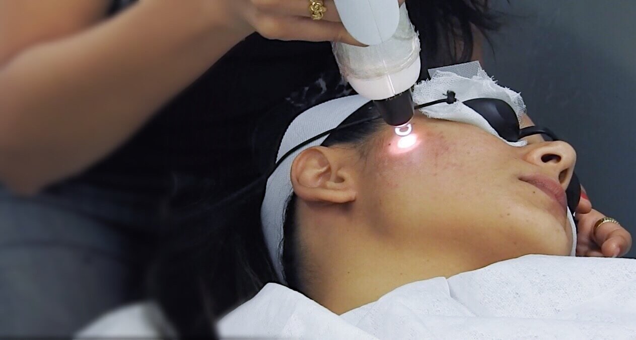 Endolift Face and Body Treatment in Multan treatment at Le Pearl Aesthetic Clinic