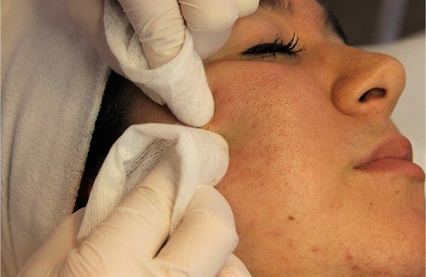 Chemical Peel in Multan for Acne, Pigment and Texture treatment at Le Pearl Aesthetic Clinic