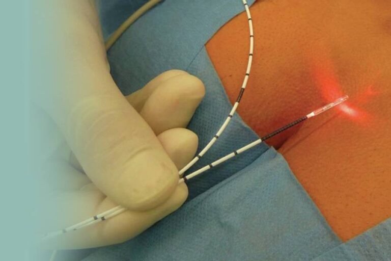 Pilonidal Sinus Treatment in Multan: From Abscess to Recovery treatment at Le Pearl Aesthetic Clinic