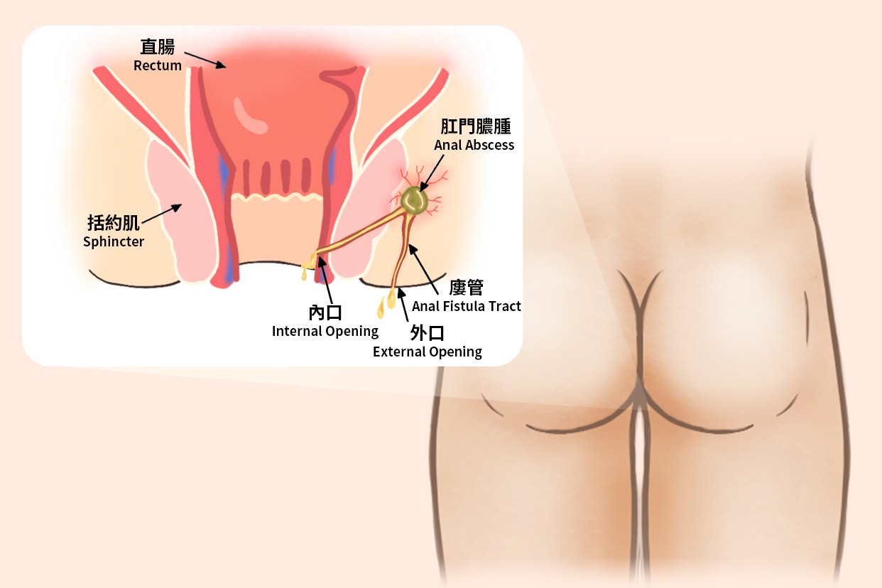 Anal Fistula Treatment in Multan: Mapping, Surgery and Recovery treatment at Le Pearl Aesthetic Clinic