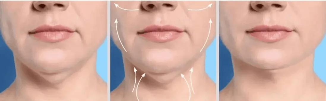 Consultation for facelift surgery in Multan showing jawline assessment