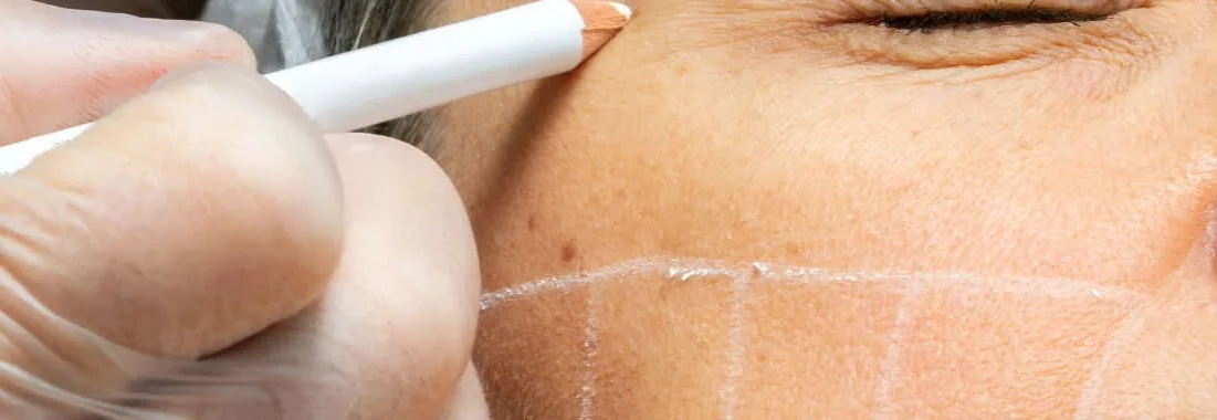 HIFU device applying focused ultrasound energy to lift and tighten facial skin