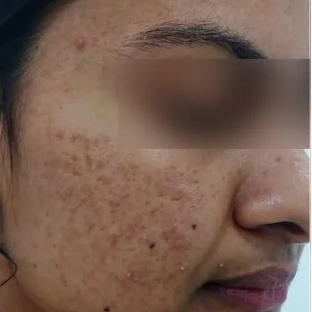Before Acne Scar Treatment