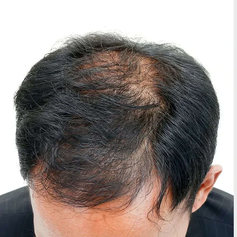 Before Exosome Hair Therapy