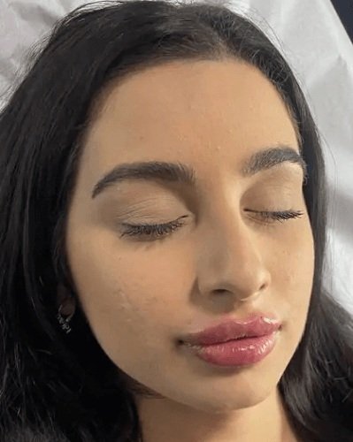 After Lip Fillers