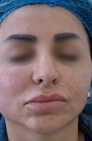 After Endolift Face Treatment