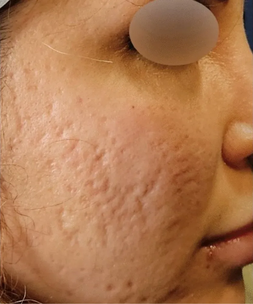 RF Microneedling in Multan before treatment
