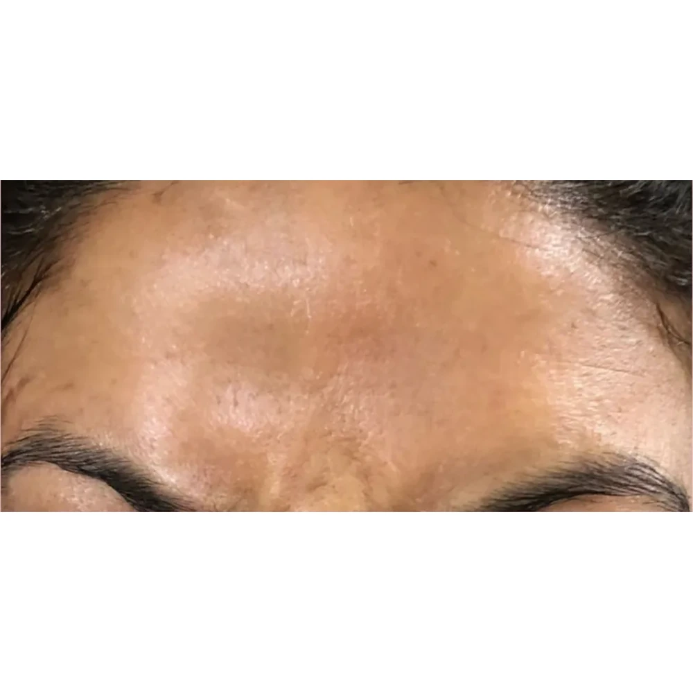 After Botox