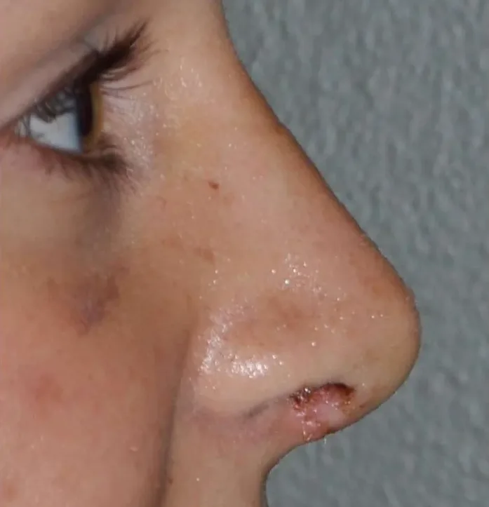 Rhinoplasty in Multan after treatment