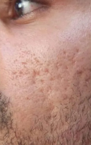 Before Microneedling Dermapen, RF and Aftercare