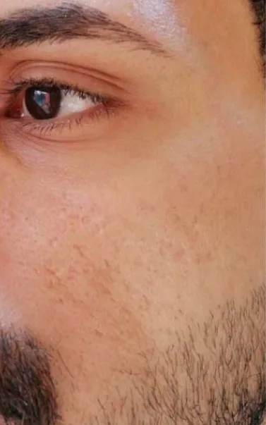 After Microneedling Dermapen, RF and Aftercare