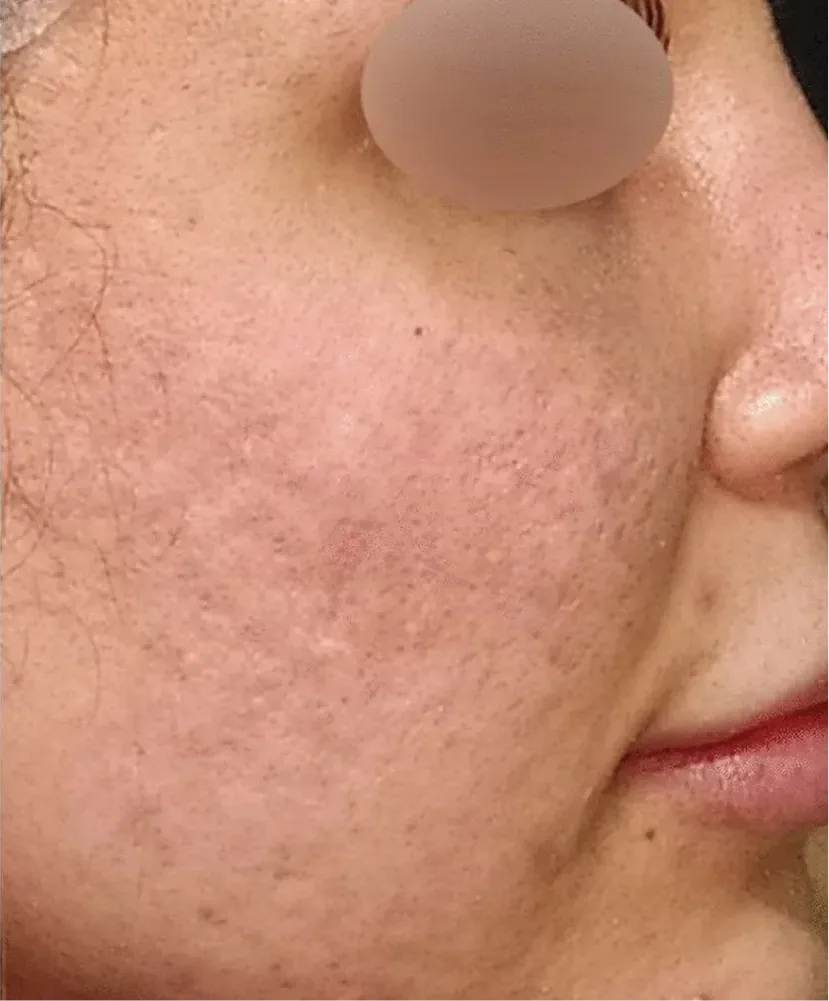 RF Microneedling in Multan after treatment