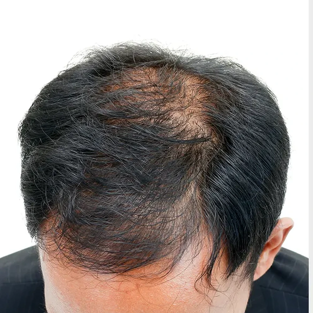 Before Hair Loss Treatment