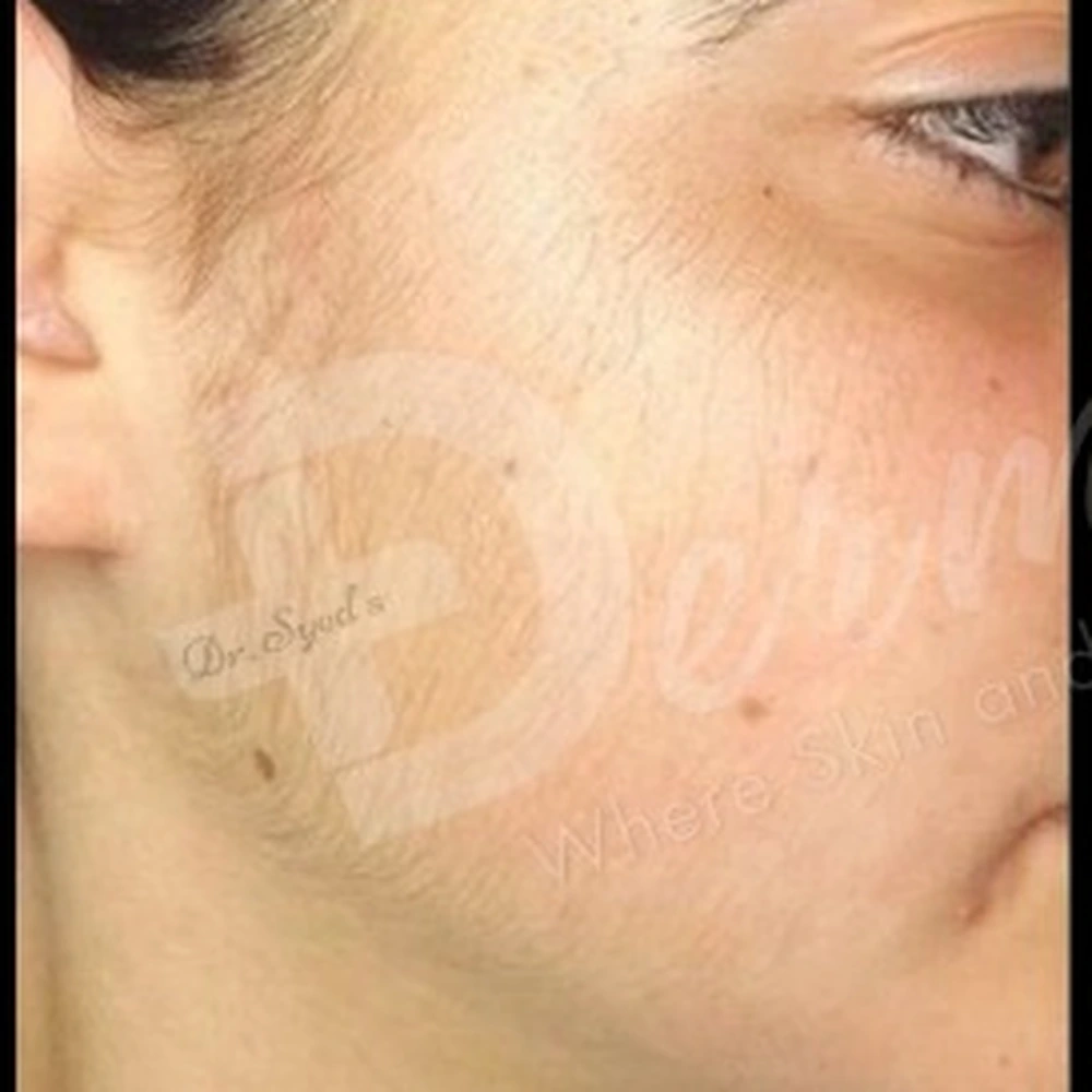 Before Laser Hair Removal