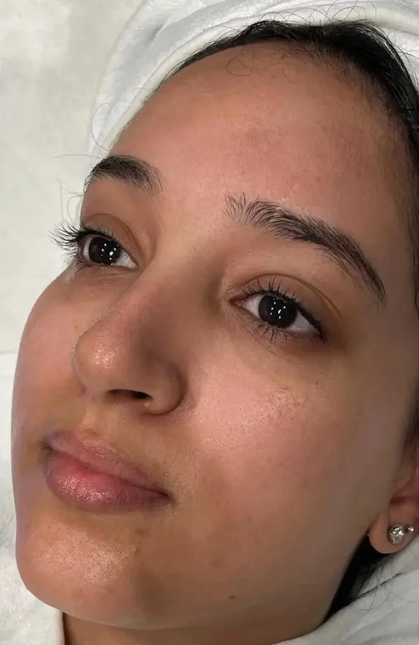 Before HydraFacial