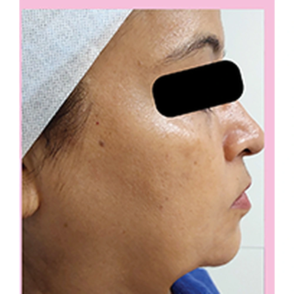 After Skin Tightening Treatment