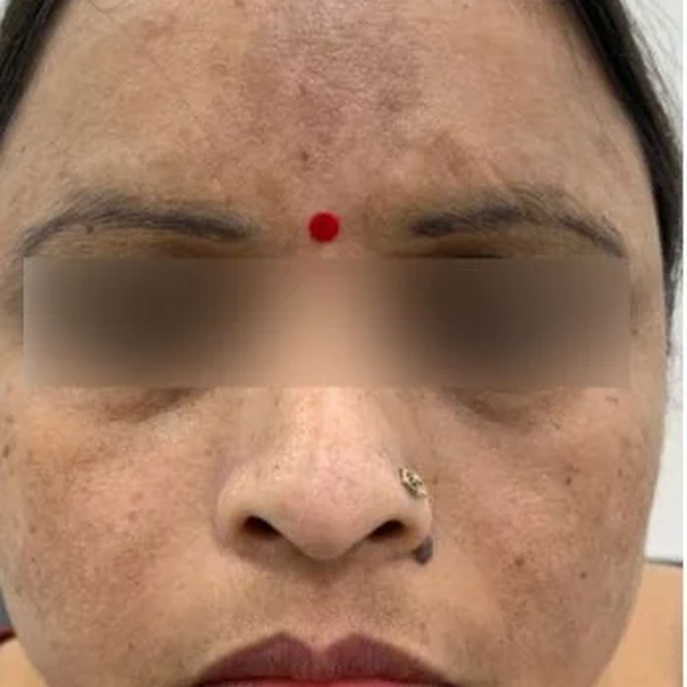 Before Melasma Treatment