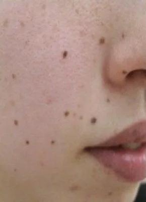 Before Mole Removal Warts, Skin Tags and Safety