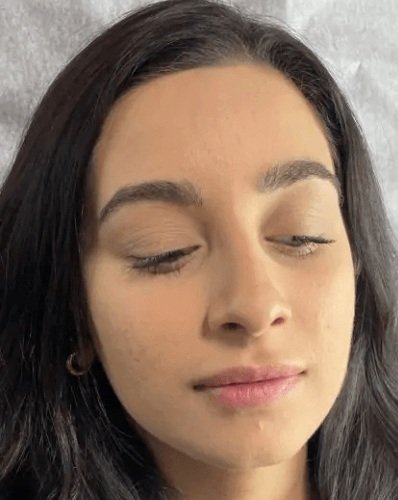Before Lip Fillers