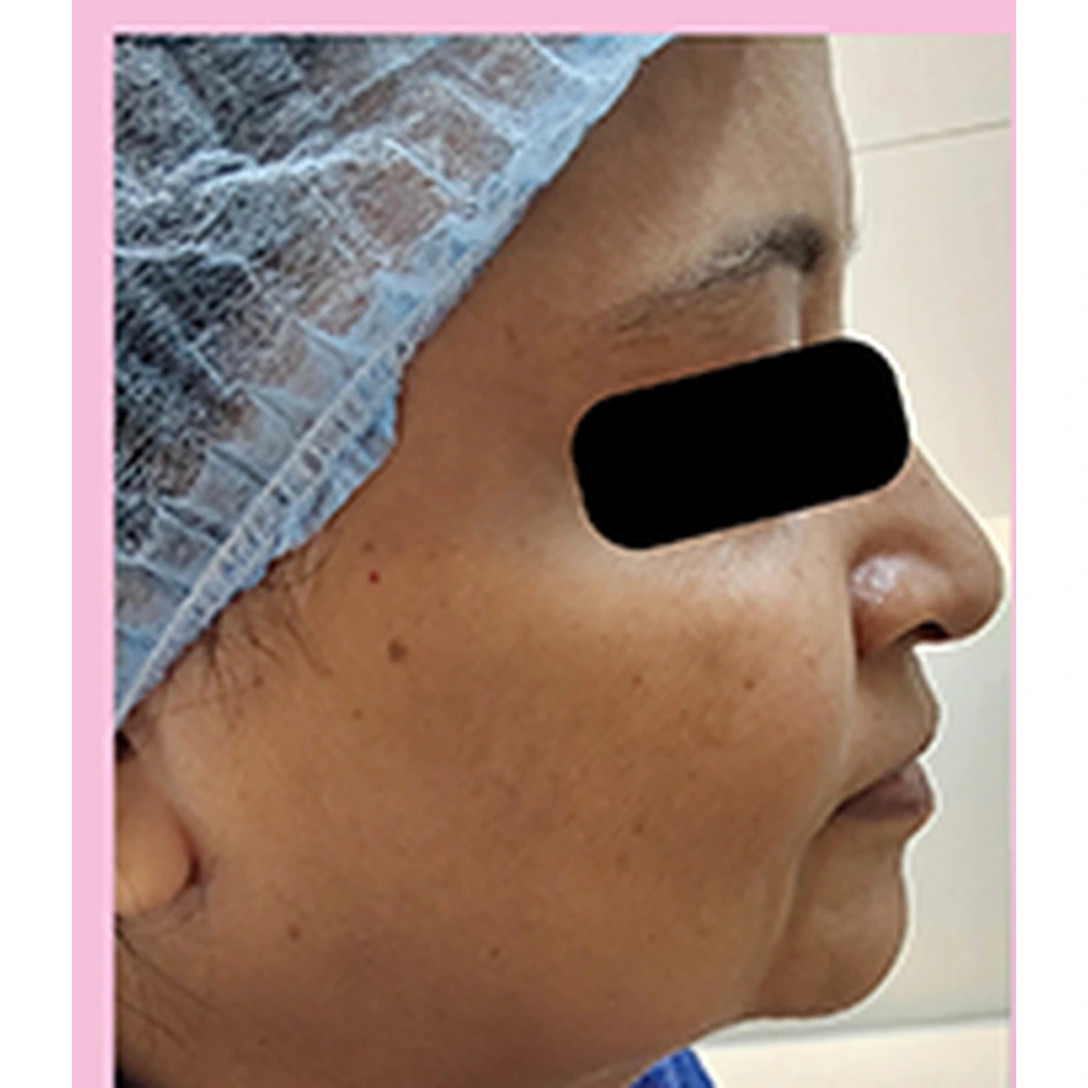 Before Skin Tightening Treatment