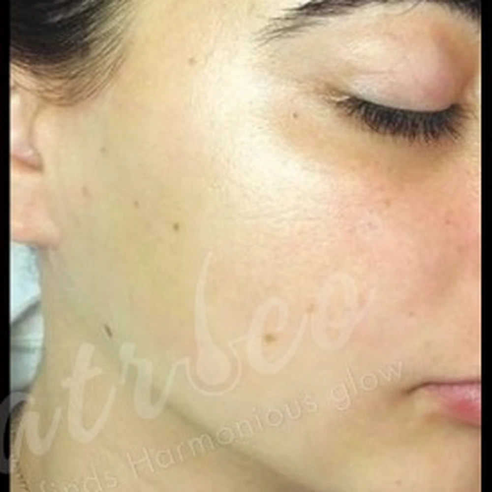 After Laser Hair Removal