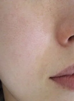 After Mole Removal Warts, Skin Tags and Safety