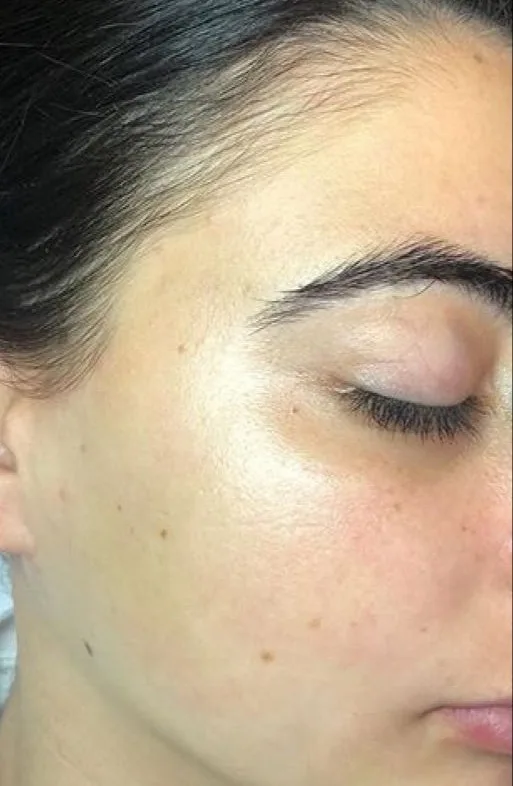 After Laser Hair Removal