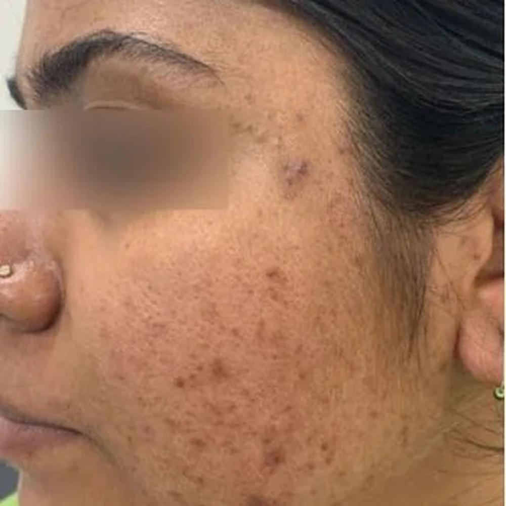 Before Acne Treatment
