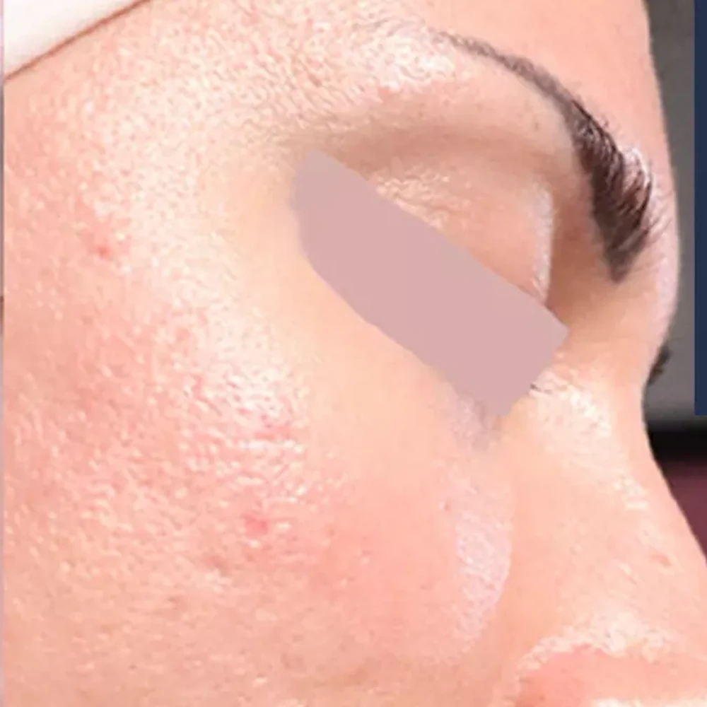 After Open Pores Treatment