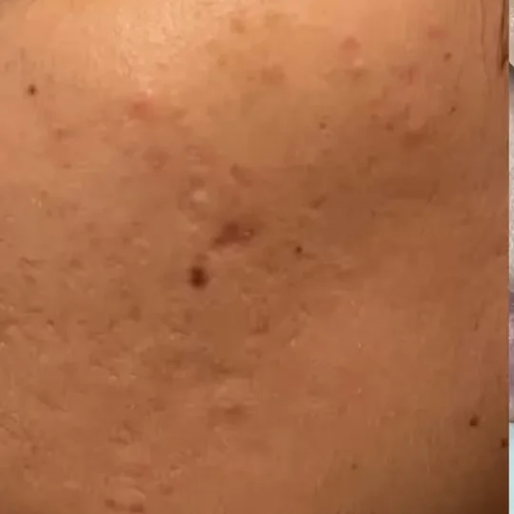Before Microneedling Dermapen, RF and Aftercare