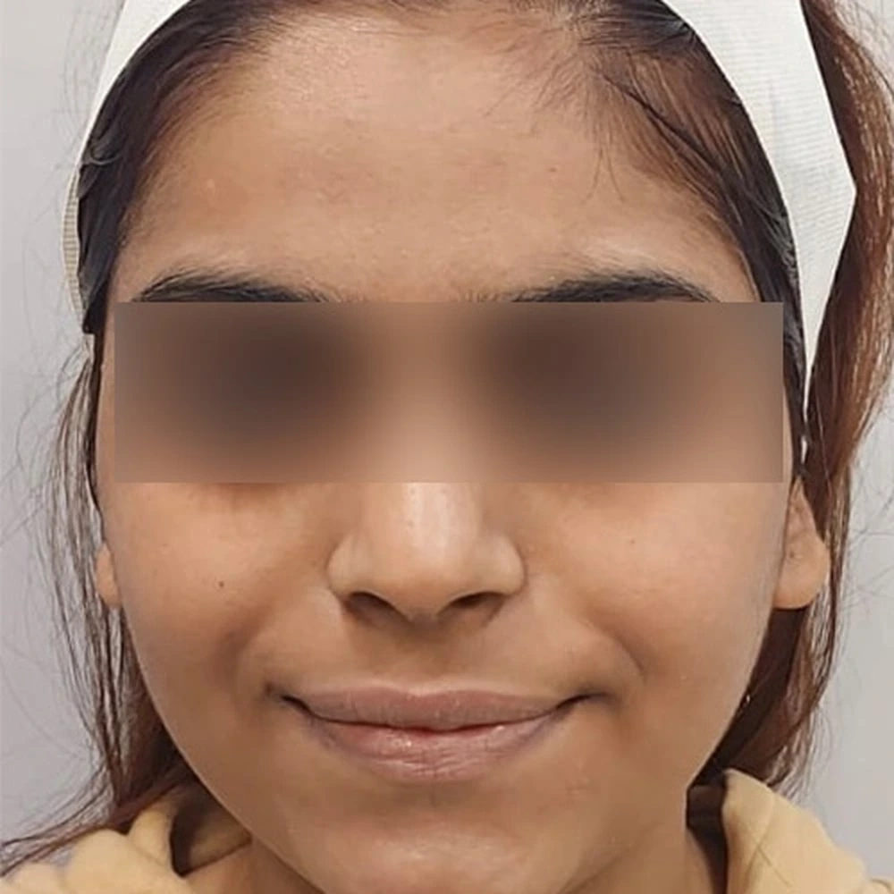 After HydraFacial