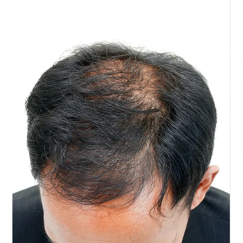 Before PRP Hair Treatment