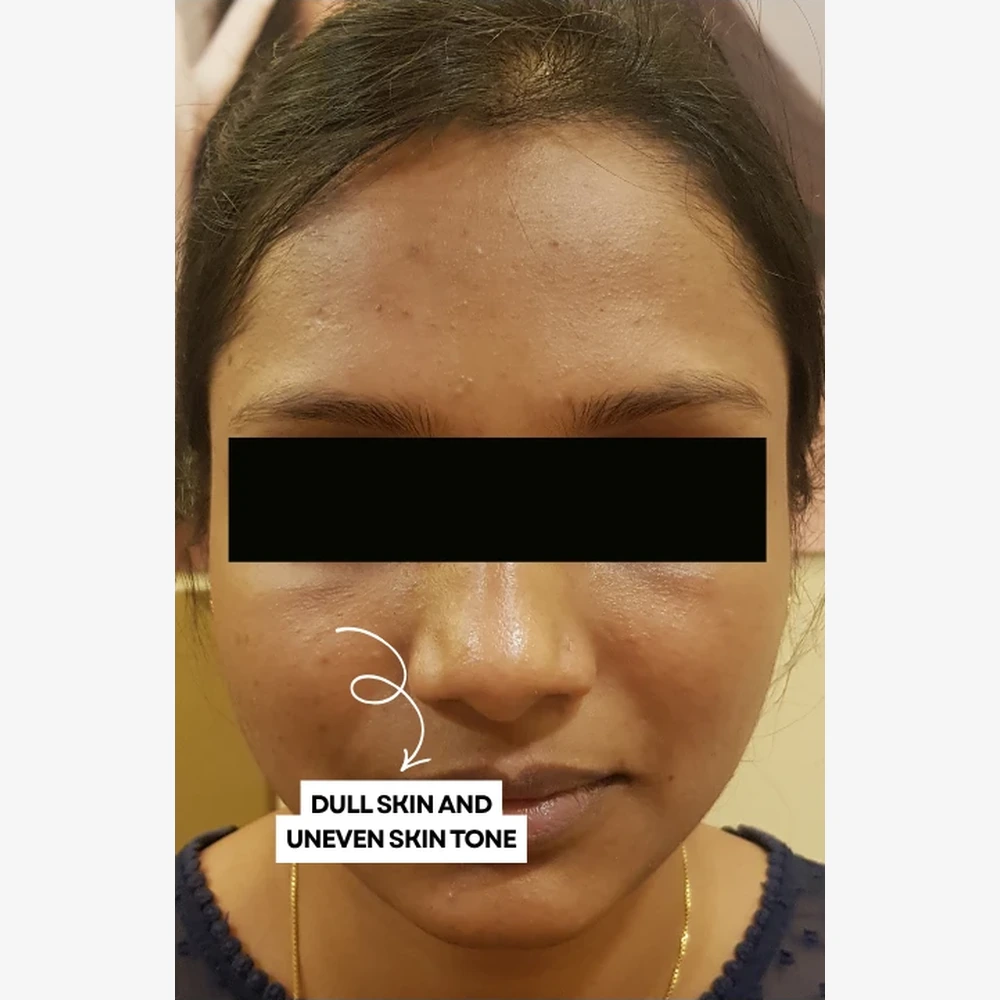 Before Skin Whitening Treatment