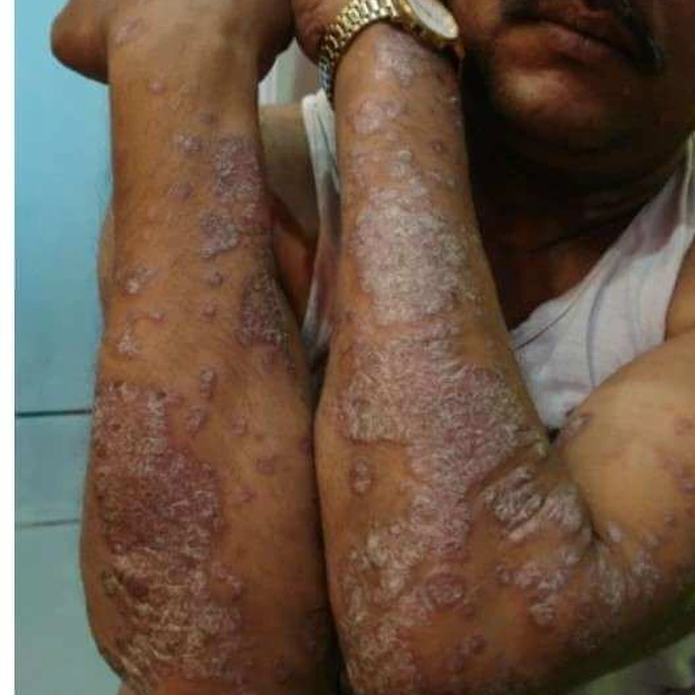 Before Psoriasis Treatment