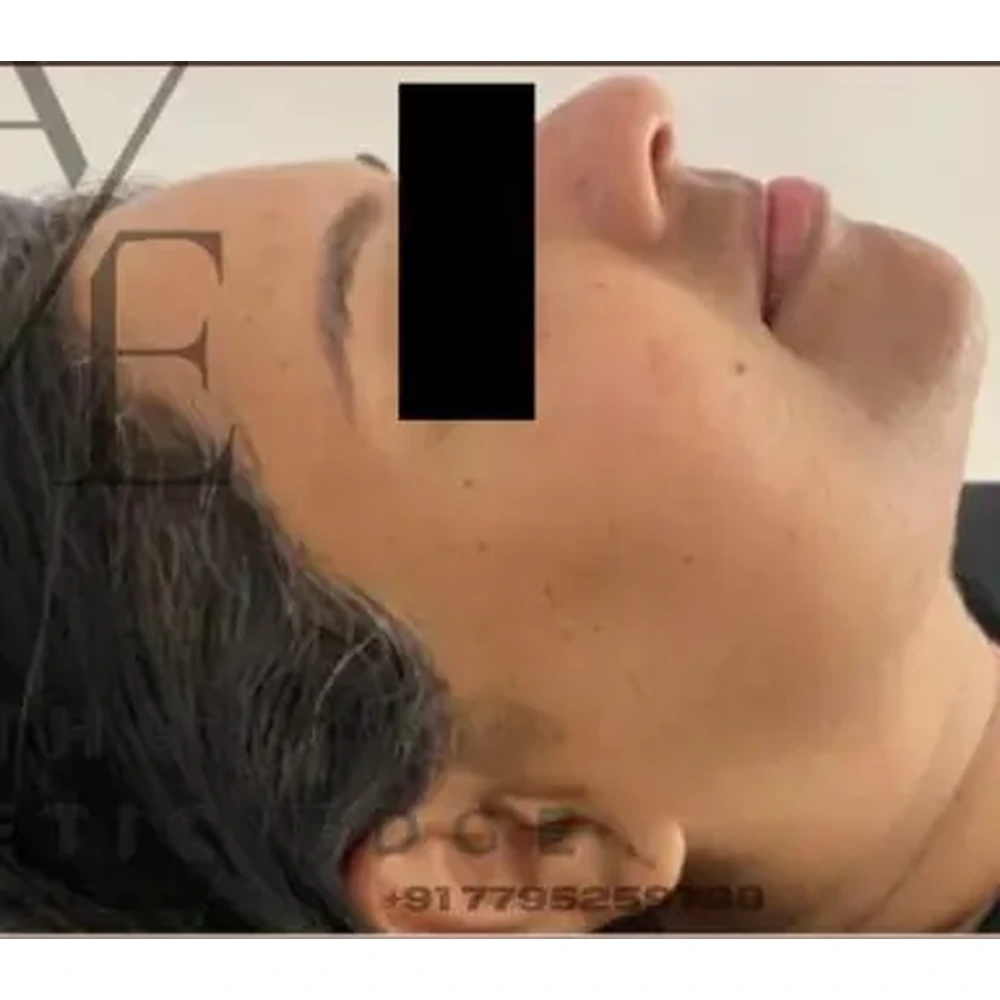 After Non-Surgical Facelift