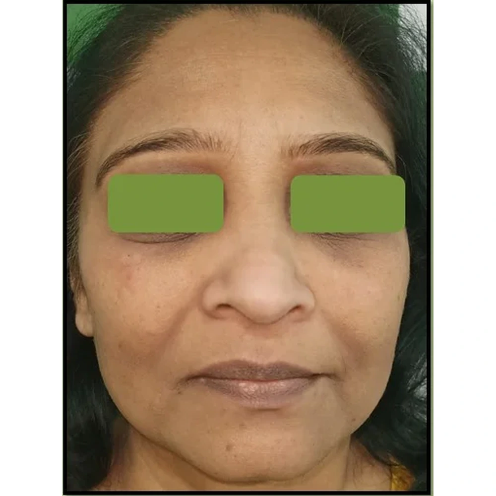 After Dermal Fillers