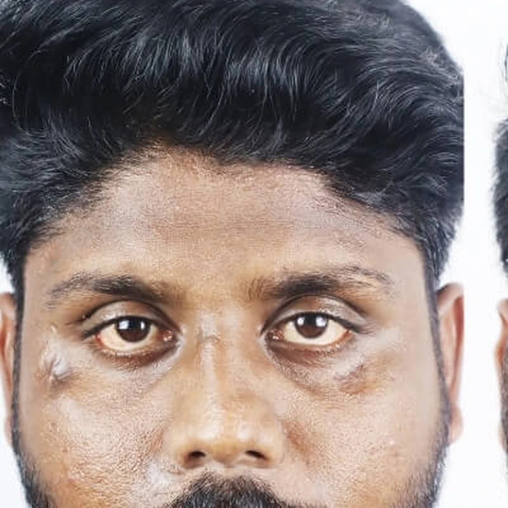 Scar Treatment in Multan for Different Scar Types before treatment