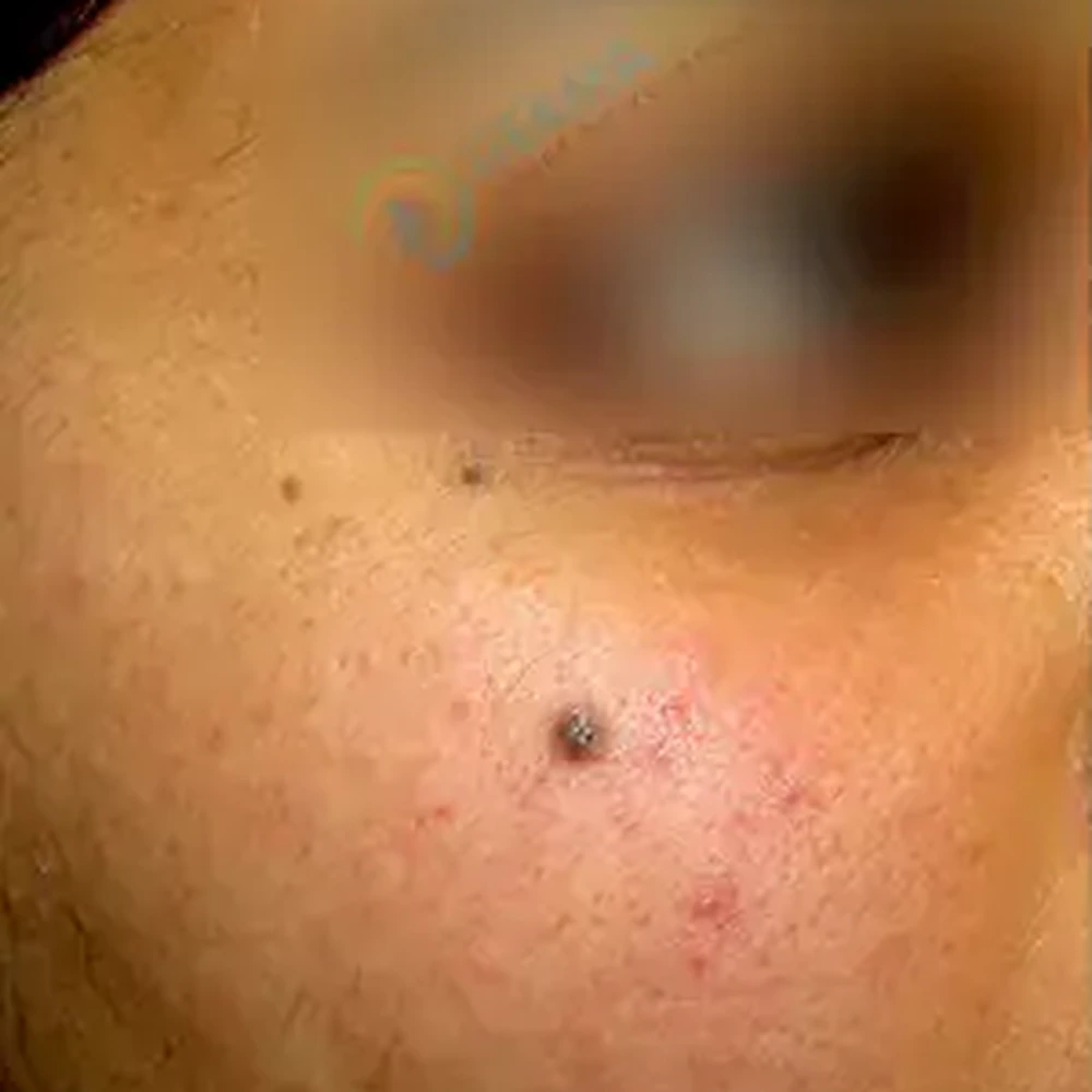 Before Mole Removal Warts, Skin Tags and Safety