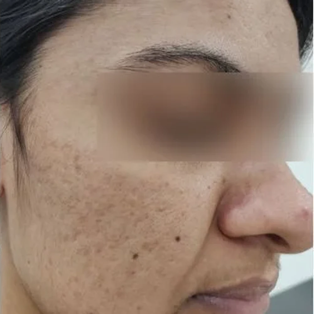 After Acne Scar Treatment