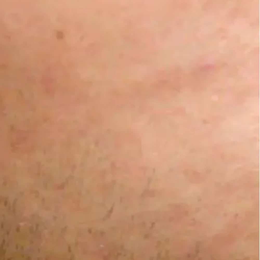 After PRP Facial